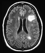 esclerosis multiple