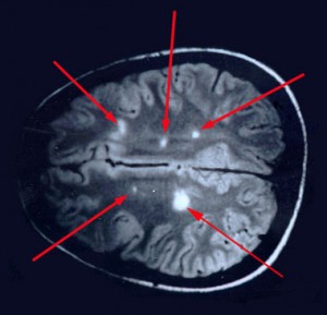 esclerosis_multiple_04